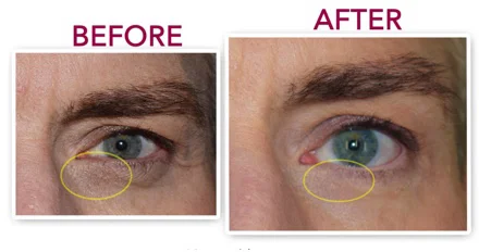 Genucel before after