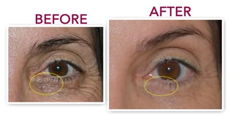 Genucel before after image